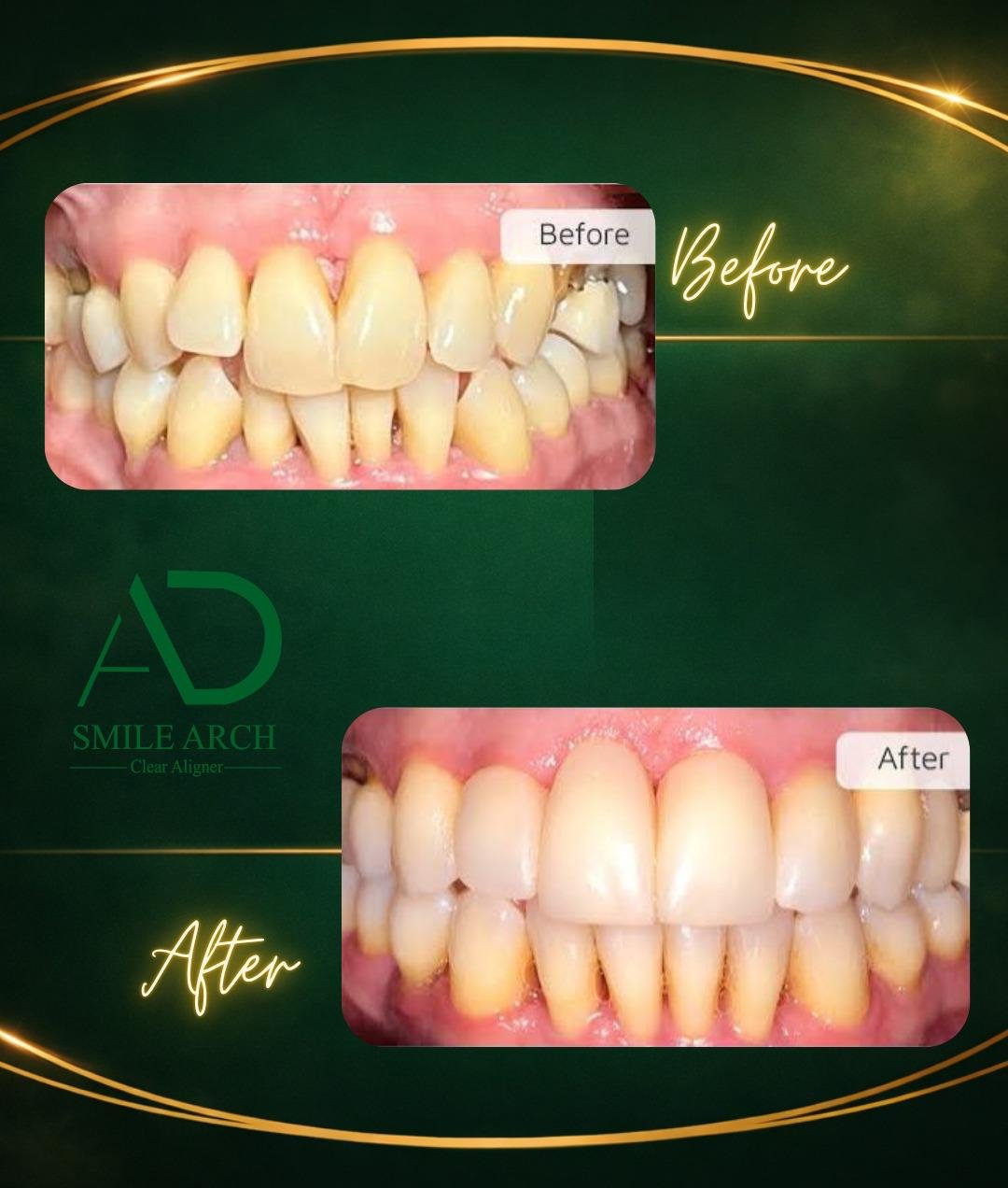 Smile transformation: gap correction before and after