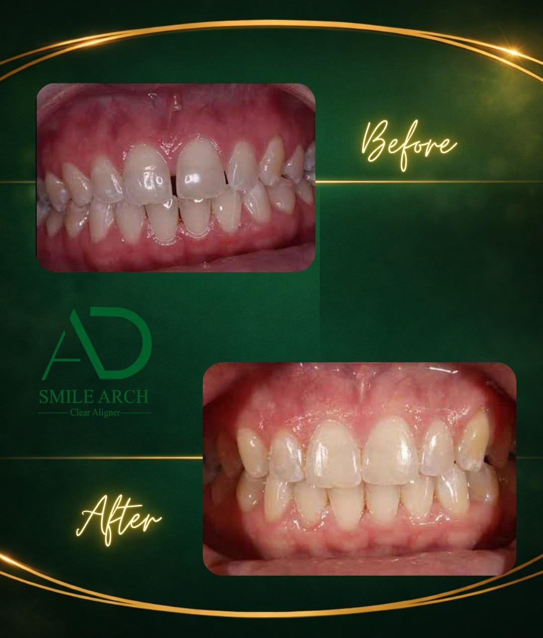Smile transformation: bite correction front view