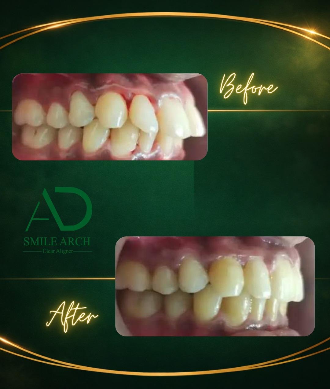 Smile transformation: crowding correction side view